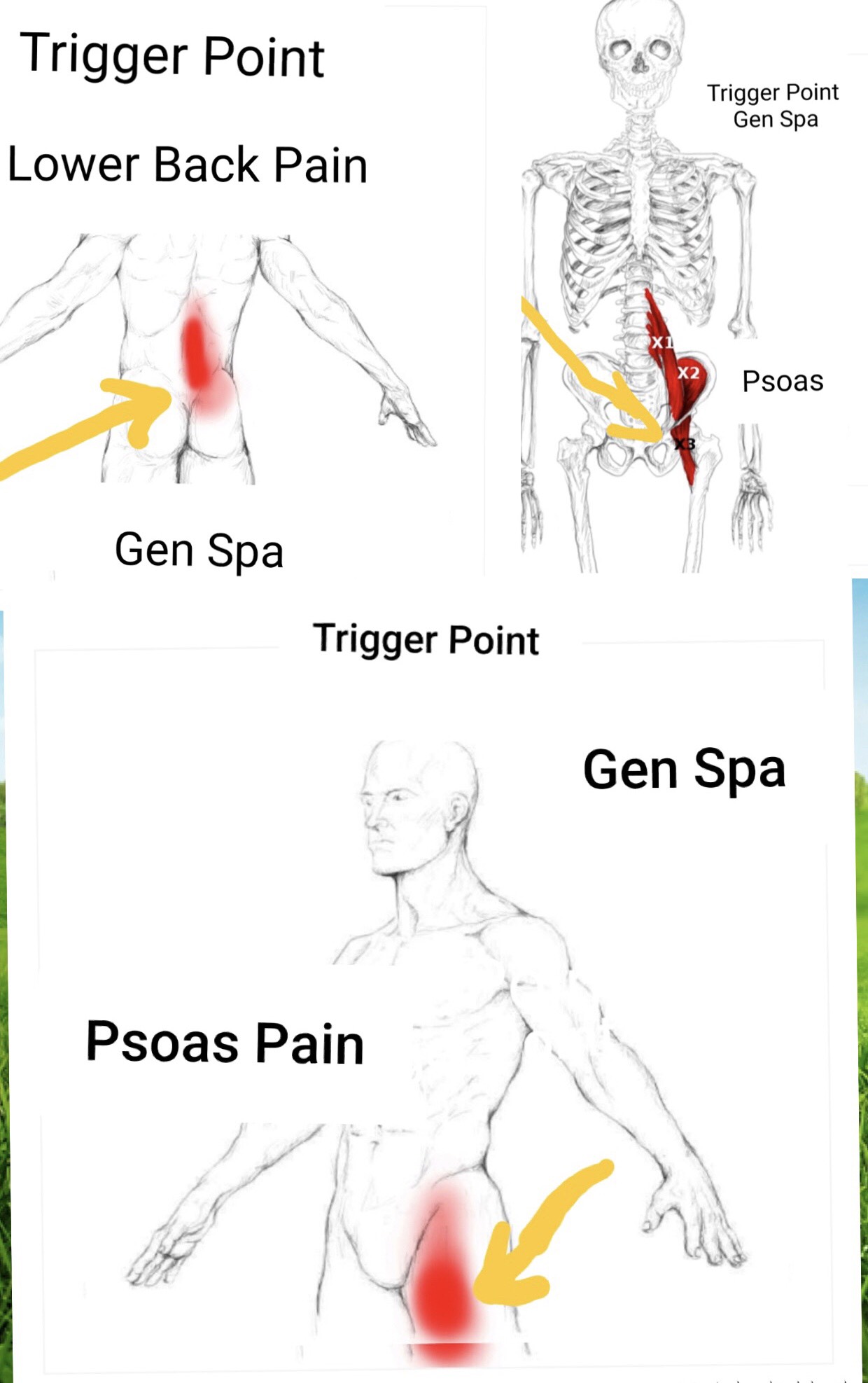 What is Psoas Syndrome?